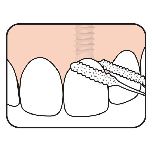 TePe Bridge and Implant Floss usage illustration for cleaning of dental bridge