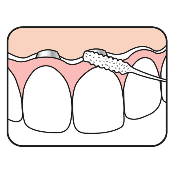 TePe Bridge and Implant Floss usage illustration for cleaning of dental implants