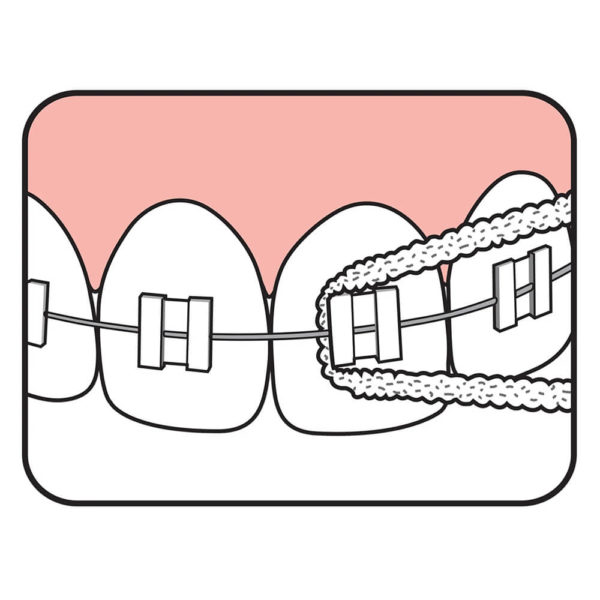 TePe Bridge and Implant Floss usage illustration for cleaning of braces