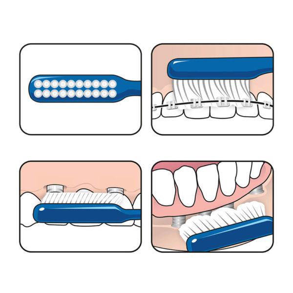 TePe Implant Orthodontic Toothbrush illustration